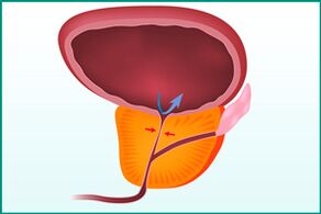 Ingrossamento della prostata e compressione dell'uretra