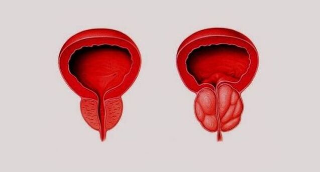 Prostata sana (a sinistra) e infiammata a causa della prostatite (a destra)