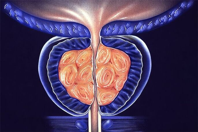 infiammazione della prostata negli uomini