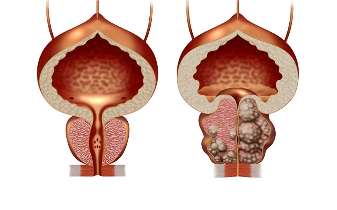 che aspetto ha l'adenoma prostatico 