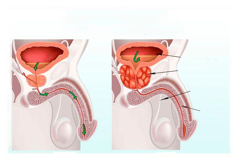 Norm e infiammazione della ghiandola prostatica