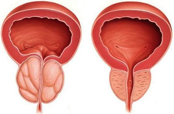prostata sana e infiammata con prostatite